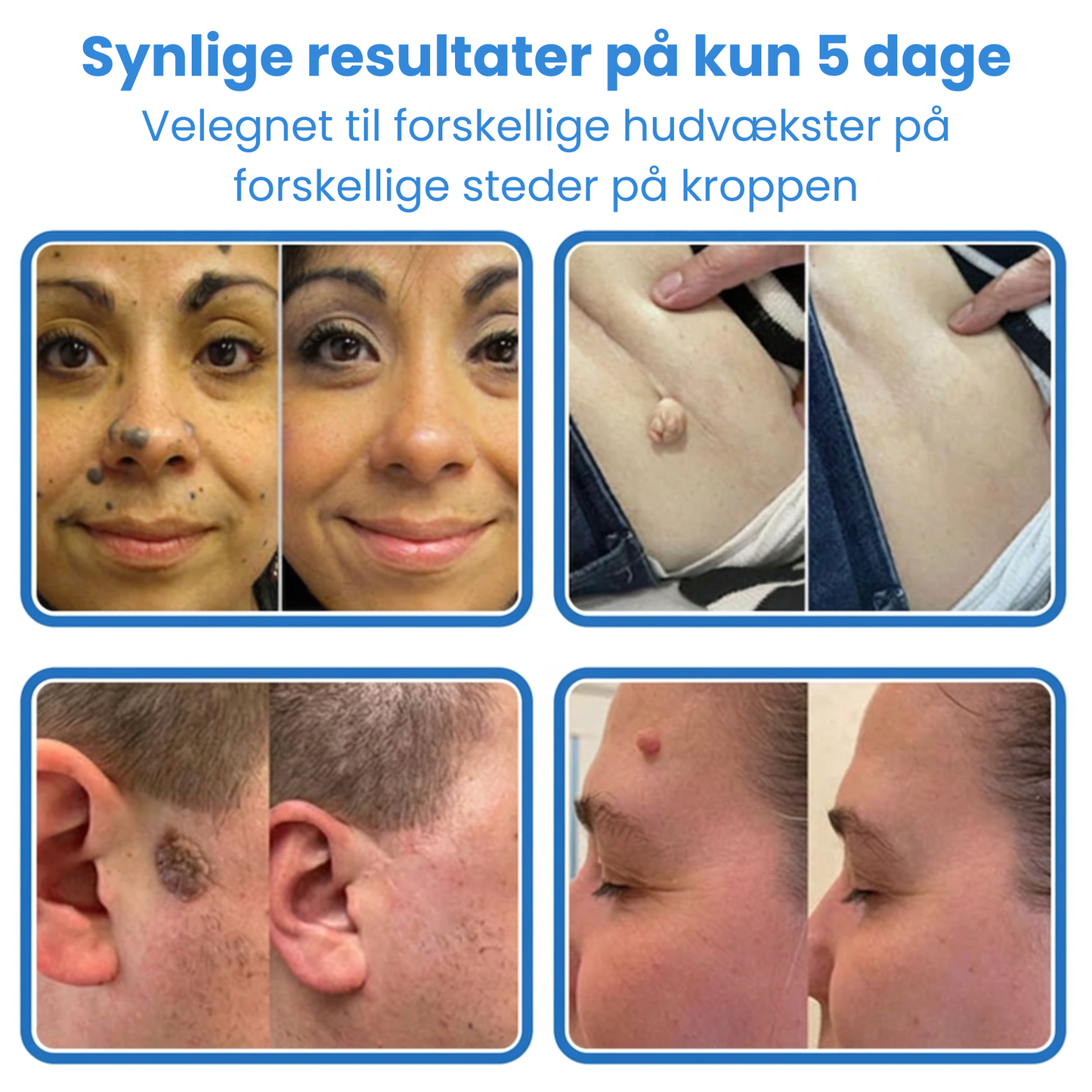 Ximonth 2-i-1 mikronål- og hydrokolloidplaster | Fjerner hævede modermærker, akne, flade vorter og hududvækster | Forbedrer rynker, ar og hudfejl | Usynlige stjerneformede plaster til ansigt og krop