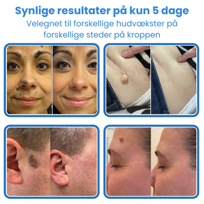 Ximonth 2-i-1 mikronål- og hydrokolloidplaster | Fjerner hævede modermærker, akne, flade vorter og hududvækster | Forbedrer rynker, ar og hudfejl | Usynlige stjerneformede plaster til ansigt og krop