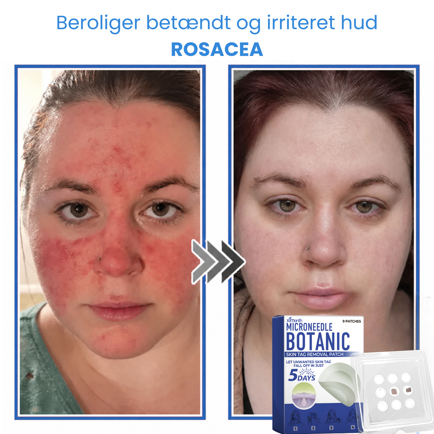 Ximonth 2-i-1 mikronål- og hydrokolloidplaster | Fjerner hævede modermærker, akne, flade vorter og hududvækster | Forbedrer rynker, ar og hudfejl | Usynlige stjerneformede plaster til ansigt og krop