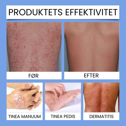 Bee Venom Psoriasis Spray | Lindrer hurtigt kløende hud