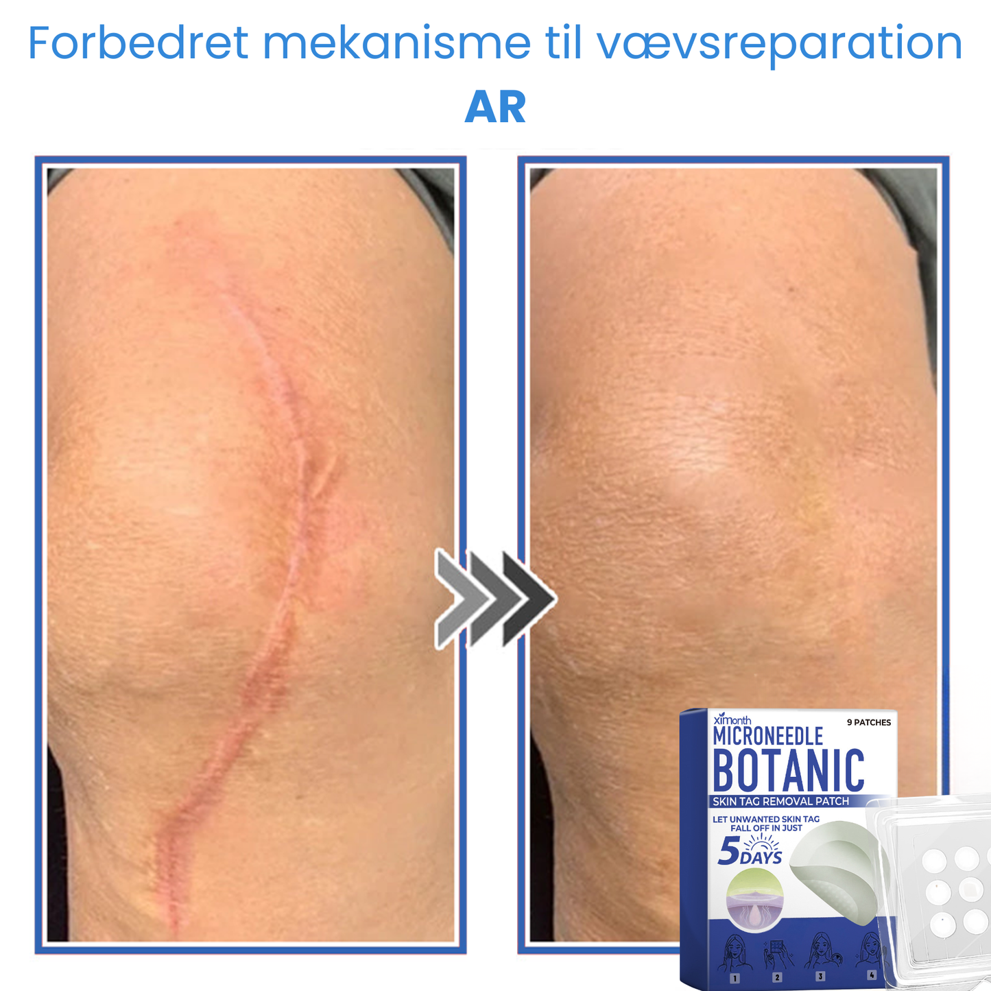 Ximonth 2-i-1 mikronål- og hydrokolloidplaster | Fjerner hævede modermærker, akne, flade vorter og hududvækster | Forbedrer rynker, ar og hudfejl | Usynlige stjerneformede plaster til ansigt og krop